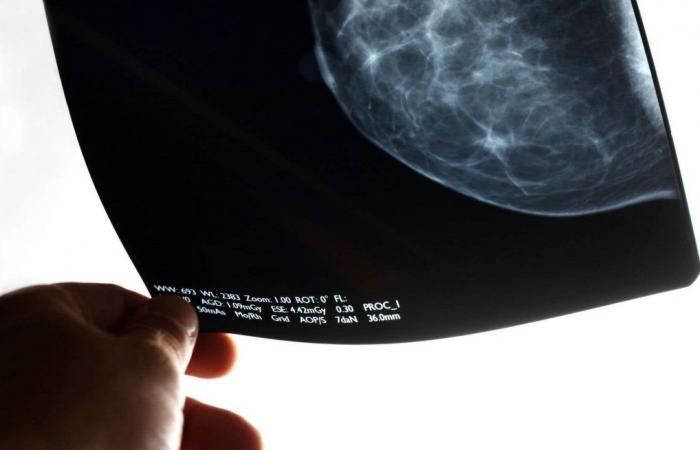 Los casos de cáncer de mama están aumentando rápidamente entre las mujeres jóvenes