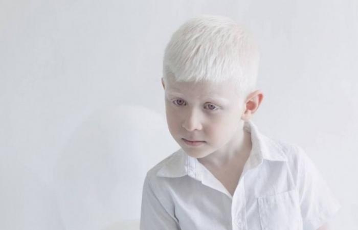 Hoy es el Día Internacional de Concientización sobre el Albinismo