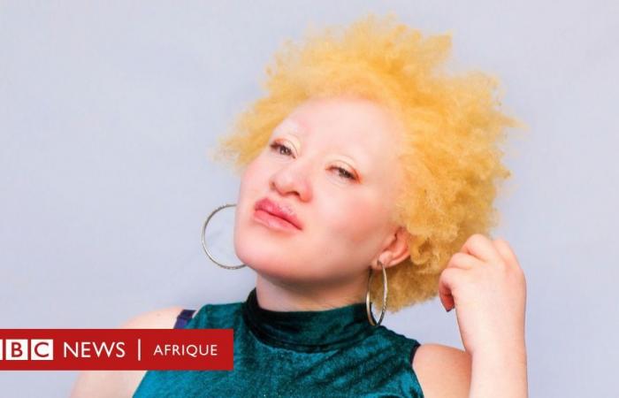 Albinismo: los mitos sobre la afección hicieron que los hombres abusaran de mí