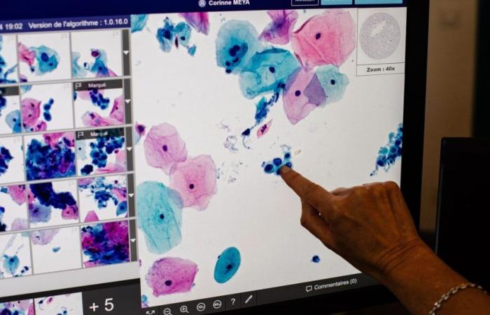 Virus del papiloma: en las Landas, jornadas de detección del cáncer de cuello uterino