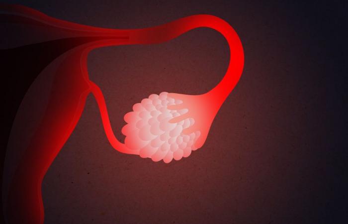 Detectar el cáncer de ovario antes de que se propague