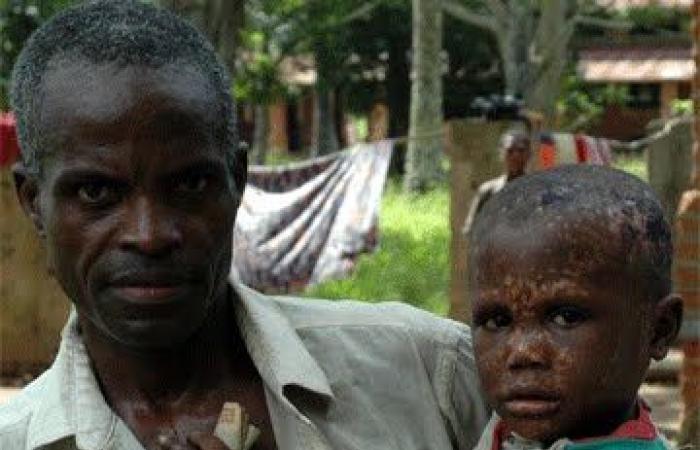 Se declara viruela simica en Kivu del Norte