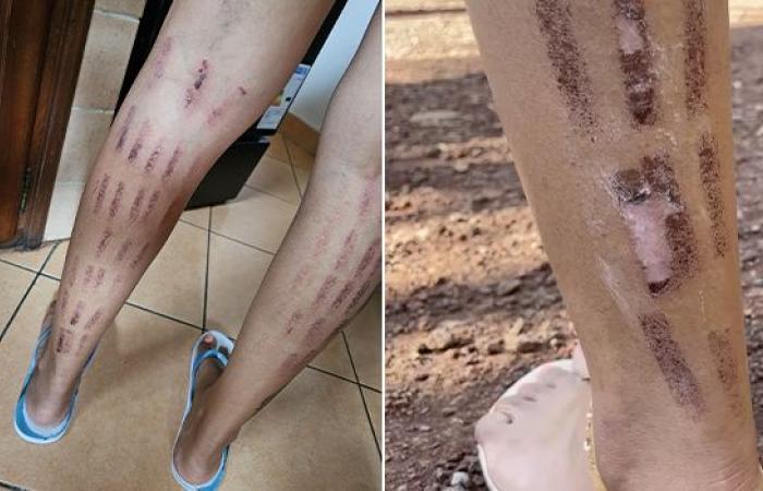 Saint-Denis: una clienta se quemó las piernas tras una sesión de depilación con luz pulsada