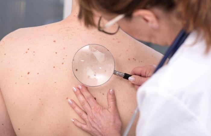 ¿Cómo reconocer los primeros signos de cáncer de piel?