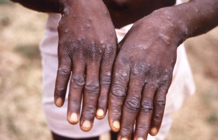 Identificado
      en
      Marruecos
      un
      caso
      de
      la
      nueva
      variante
      del
      MPOX,
      el
      primero
      en
      el
      norte
      de
      África