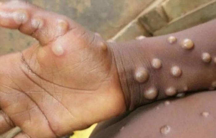 MPOX golpea duramente a los niños de Burundi