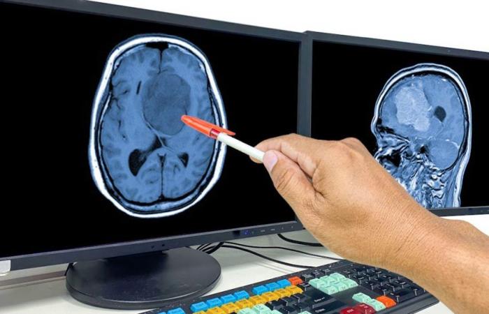 Un gran avance en la lucha contra el cáncer de cerebro