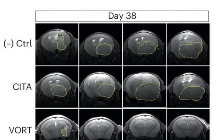 Un antidepresivo común resulta prometedor para el tratamiento del glioblastoma.