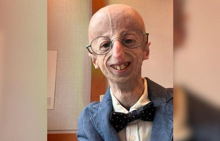 Sammy Basso, el paciente más viejo del mundo que sufre envejecimiento prematuro, murió a los 28 años