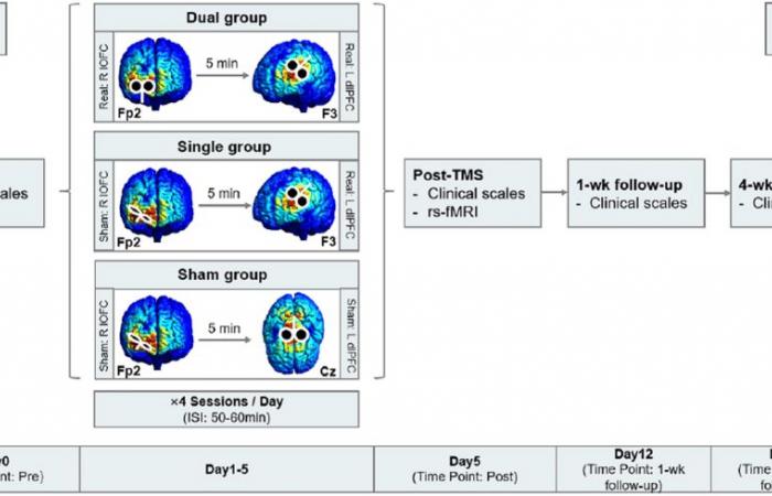 Los pulsos magnéticos dirigidos a dos regiones del cerebro reducen los síntomas en 5 días.