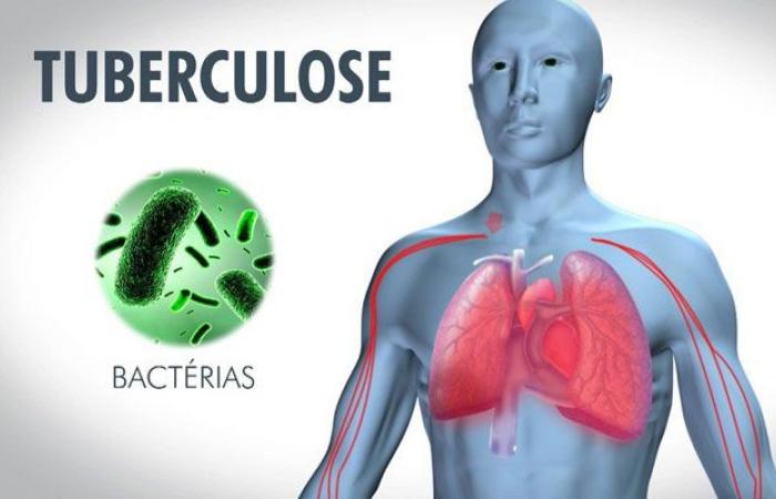 OMS: La tuberculosis en 2023 alcanza un récord con 8,2 millones de nuevos casos