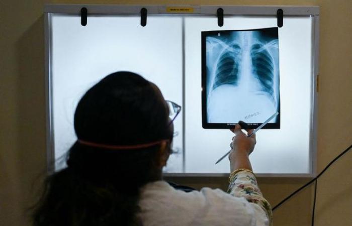 OMS: Nuevo récord mundial de casos de tuberculosis en 2023