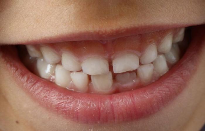 ¿Qué es MIH, esta enfermedad que destruye el esmalte de los dientes de los niños y favorece la caries?