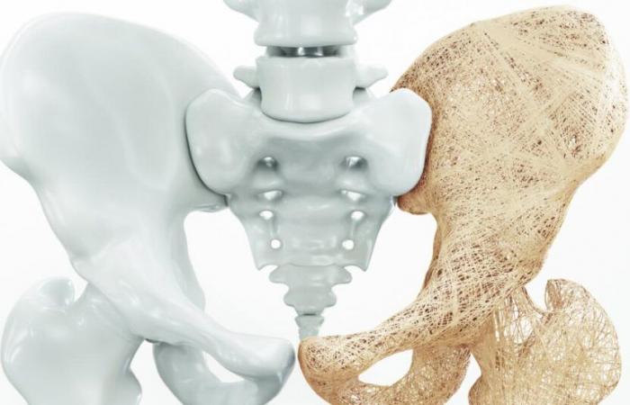 Detección de osteoporosis en 4 preguntas