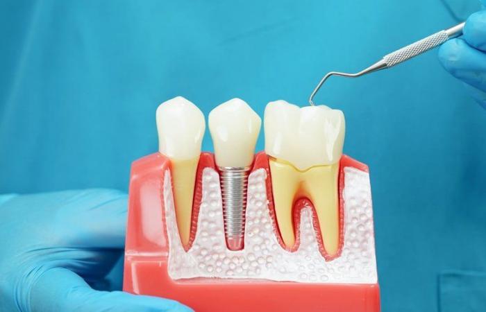 ¿Finalmente reembolsados ​​los implantes y prótesis dentales? La Alta Autoridad Sanitaria emite un dictamen positivo