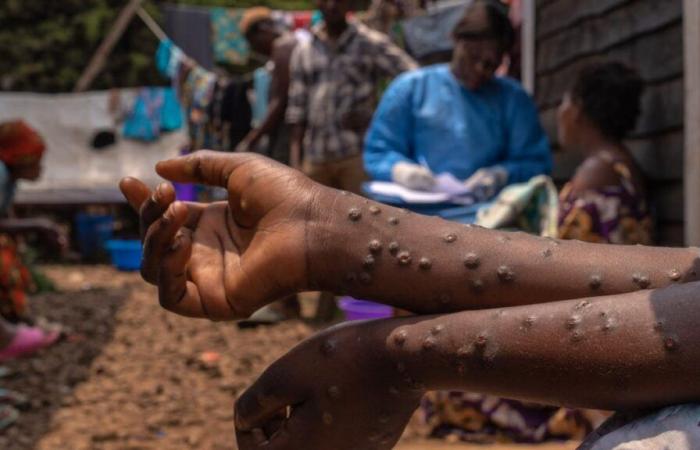 Mpox: ligera desaceleración de la contaminación en África