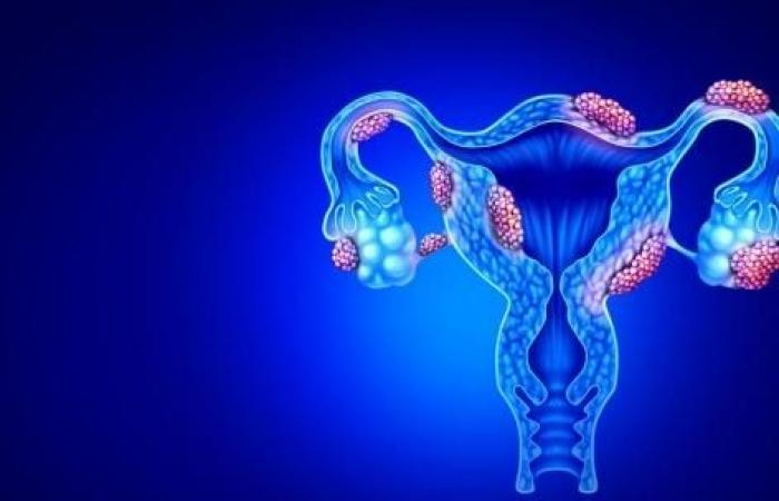 Endometriosis: un descubrimiento podría explicar el dolor y el crecimiento de las lesiones