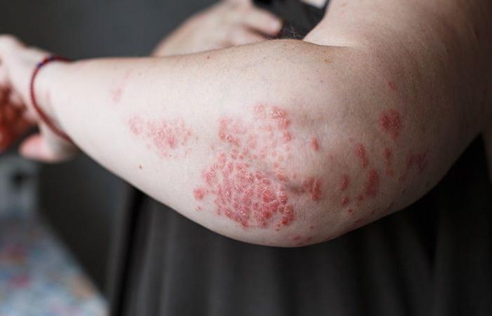 Zasocitinib, otro inhibidor de Tyk2 para tratar la psoriasis oral