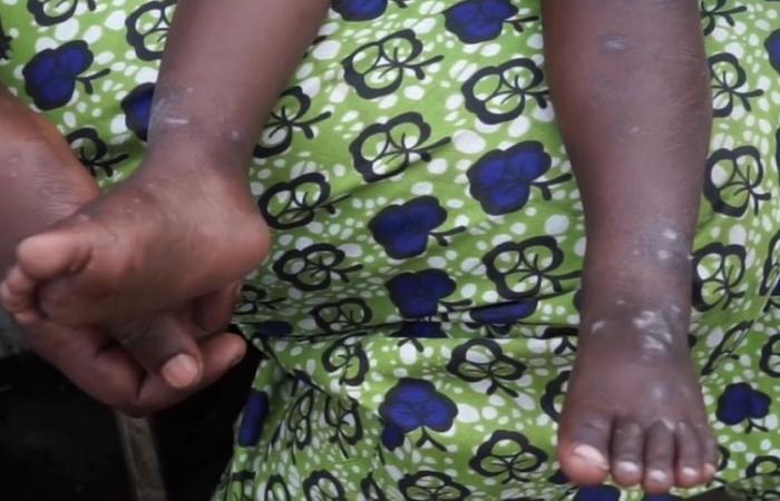 Mpox: la epidemia va en aumento entre los niños de la República Democrática del Congo y Burundi