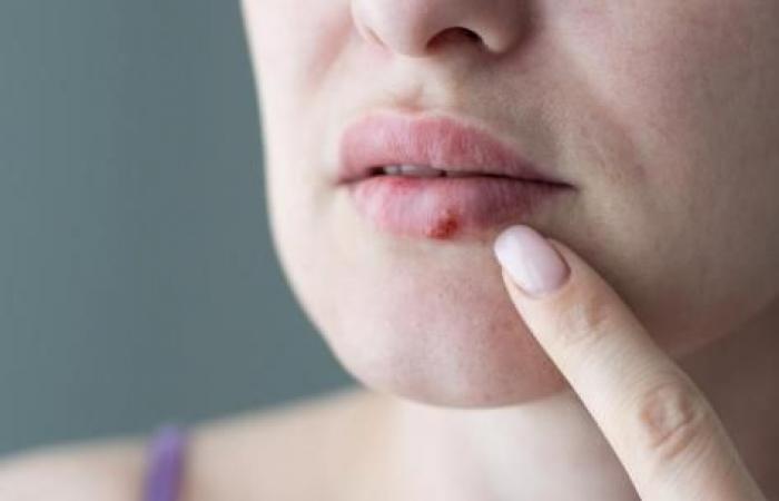 El virus del herpes labial puede llegar al cerebro