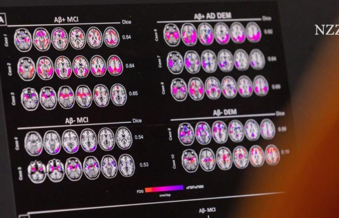 El medicamento contra el Alzheimer Leqembi pronto estará disponible en la UE