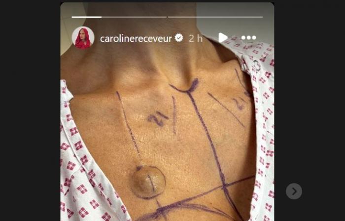 Caroline Receveur “más ligera que nunca a sus 37 años”: reducción mamaria y no más implantes, comparte fotos de su libertad