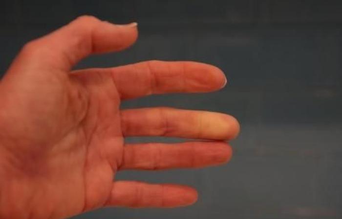 ¿Tienes las manos frías? Esta prueba de 1 minuto te dirá si tienes el síndrome de Raynaud