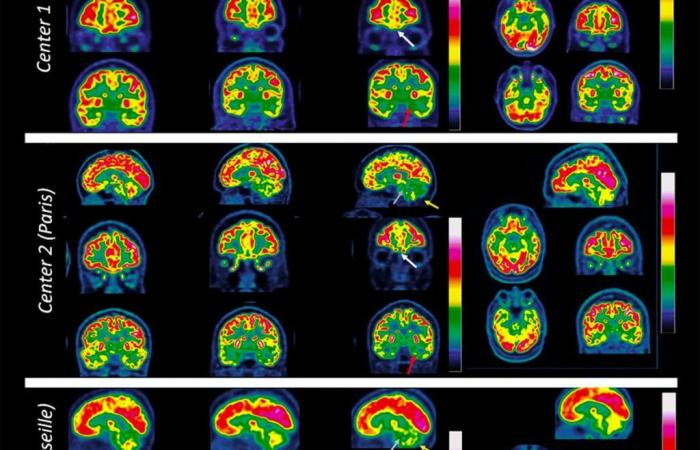 Lo que sabemos sobre el impacto de Covid en tu cerebro