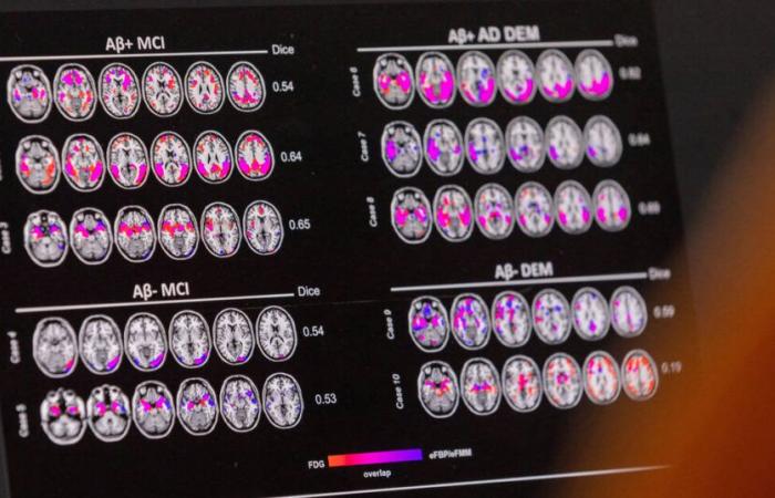 ¿Qué pasaría si la Alta Autoridad para la Salud demostrara independencia en materia de medicamentos contra el Alzheimer? – Liberación