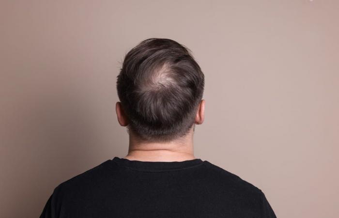 Este tratamiento para la caída del cabello masculino funciona mejor que otros