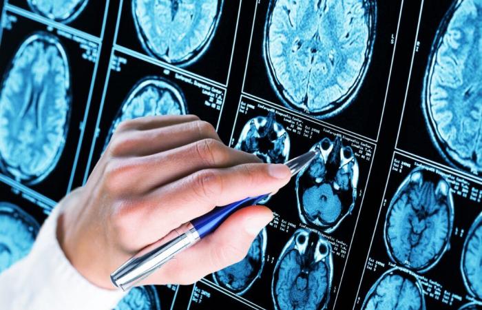 TRAUMA CEREBRAL y ALZHEIMER: ¿Cuál es el vínculo?