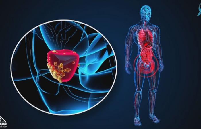 Seis cosas que hay que saber sobre el cáncer de próstata en Nueva Caledonia