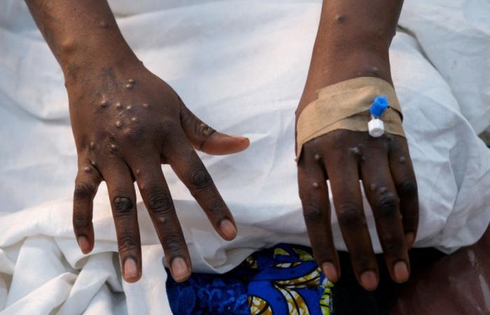 Epidemia de Mpox | La OMS mantiene su máximo nivel de alerta