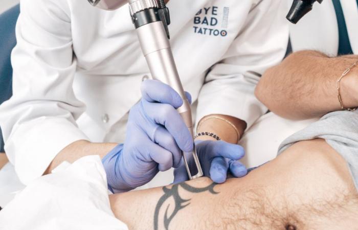 Tras el boom de los tatuajes, llega el boom de la eliminación de tatuajes