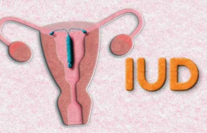 DIU hormonal y riesgo de cáncer de mama