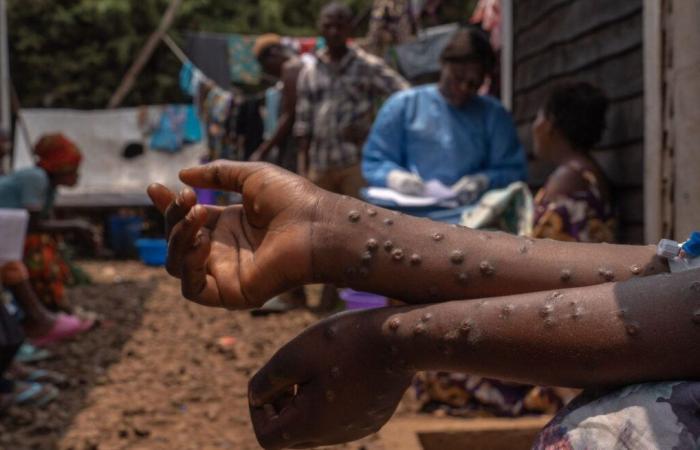 Mpox en la República Democrática del Congo: la OMS mantiene su máximo nivel de alerta | APAnoticias