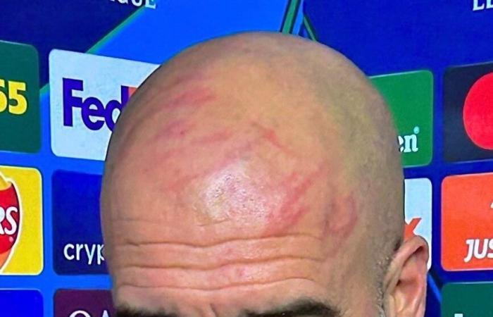 Guardiola explica que sufrió heridas en la cara tras tropezar contra el Feyenoord