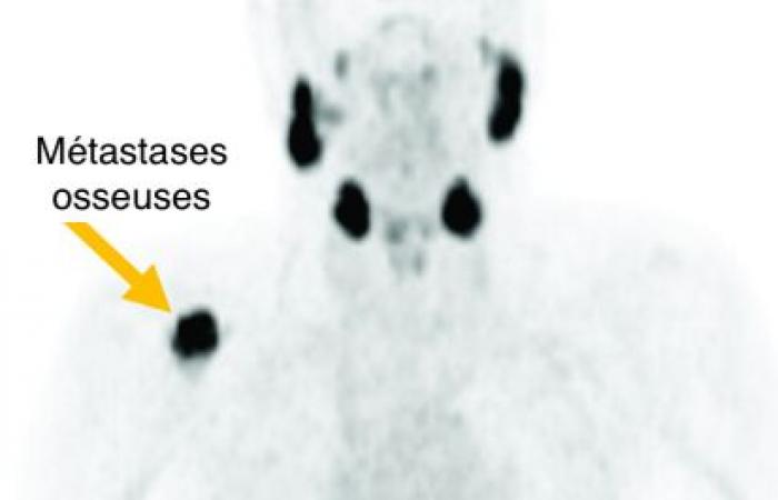 Lu-PSMA, el radiofármaco que ataca el cáncer de próstata