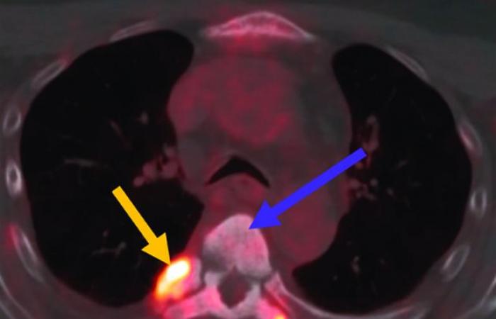 Lu-PSMA, el radiofármaco que ataca el cáncer de próstata