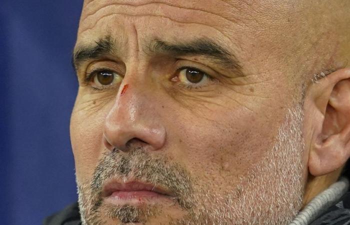 Fútbol: Guardiola vuelve a la broma tras su cicatriz en la nariz