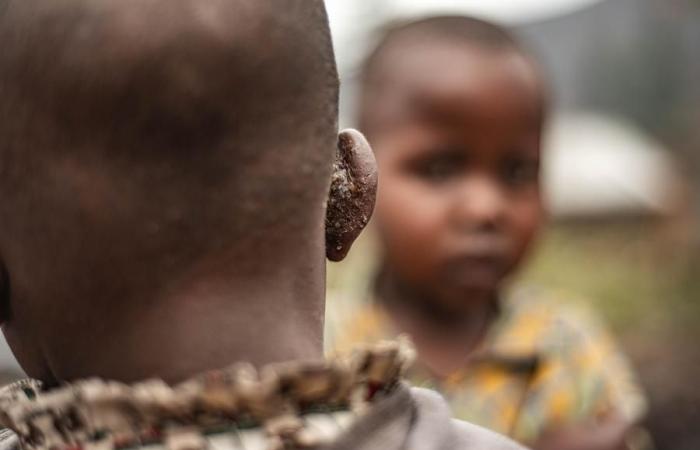 (Multimedia) Casi 60.000 casos de mpox en África, 20 países afectados (África CDC) – Xinhua