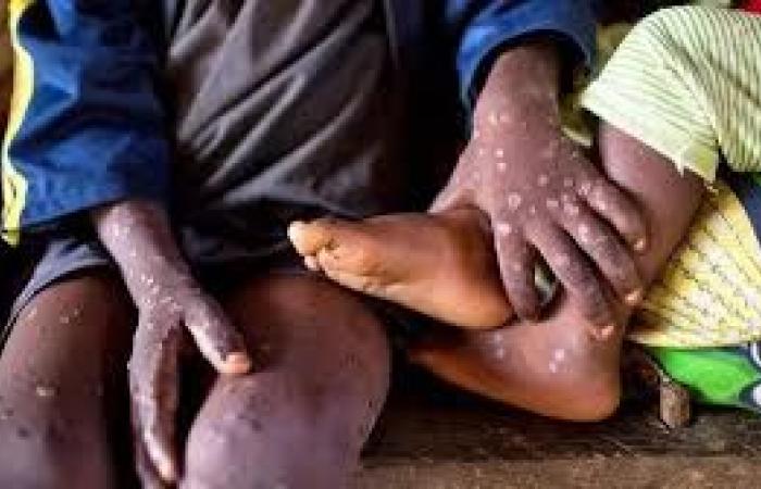 20 países africanos afectados por el virus Mpox (África CDC) | APAnoticias