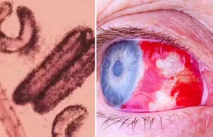 El virus del ojo sangrante causa pánico mundial mientras el mortal Marburg se extiende a 17 países