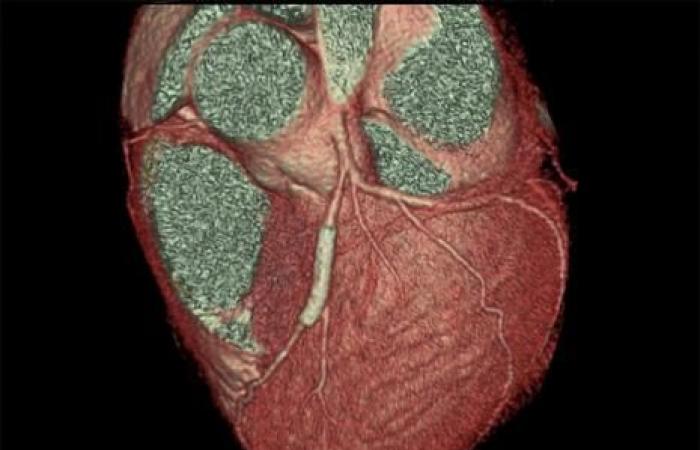 Después de la colocación del stent, clopidogrel es preferible a la aspirina a largo plazo en pacientes de riesgo