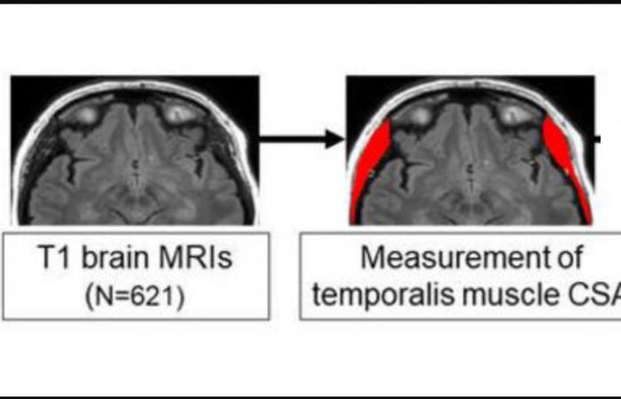 La pérdida muscular temporal podría ser una señal de advertencia del Alzheimer