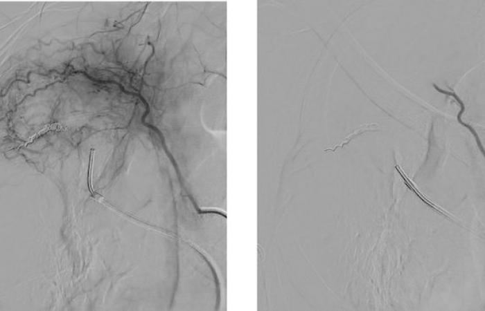 Pequeñas partículas para embolizar las arterias bronquiales periféricas.