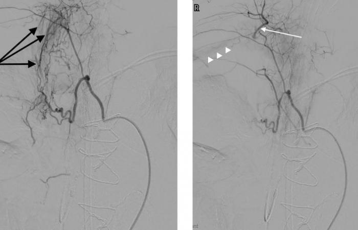 Pequeñas partículas para embolizar las arterias bronquiales periféricas.