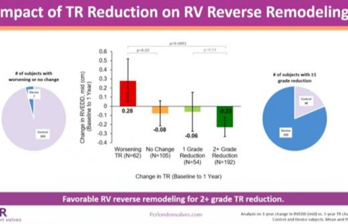 Remodelación del corazón derecho después de la reparación tricúspide con TriClip