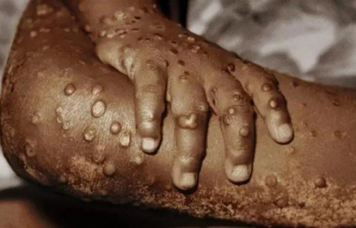 Otro caso confirmado de Mpox en el país, esta vez en Uíge