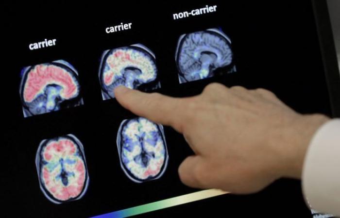 Investigadores belgas revelan el papel de las células inmunitarias del cerebro en la enfermedad de Alzheimer